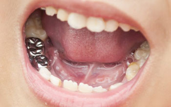 Ребенку восстановили зуб детской коронкой – что делать дальше?